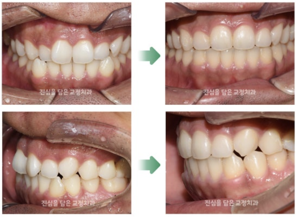 삐뚤어진 위 아래 치아를 가진 30대 환자분의 앞니 부분교정 사례